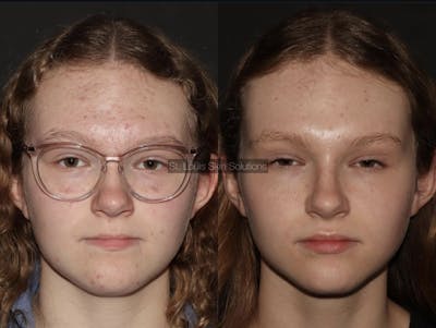 Acne Treatments Before & After Gallery - Patient 315439 - Image 1