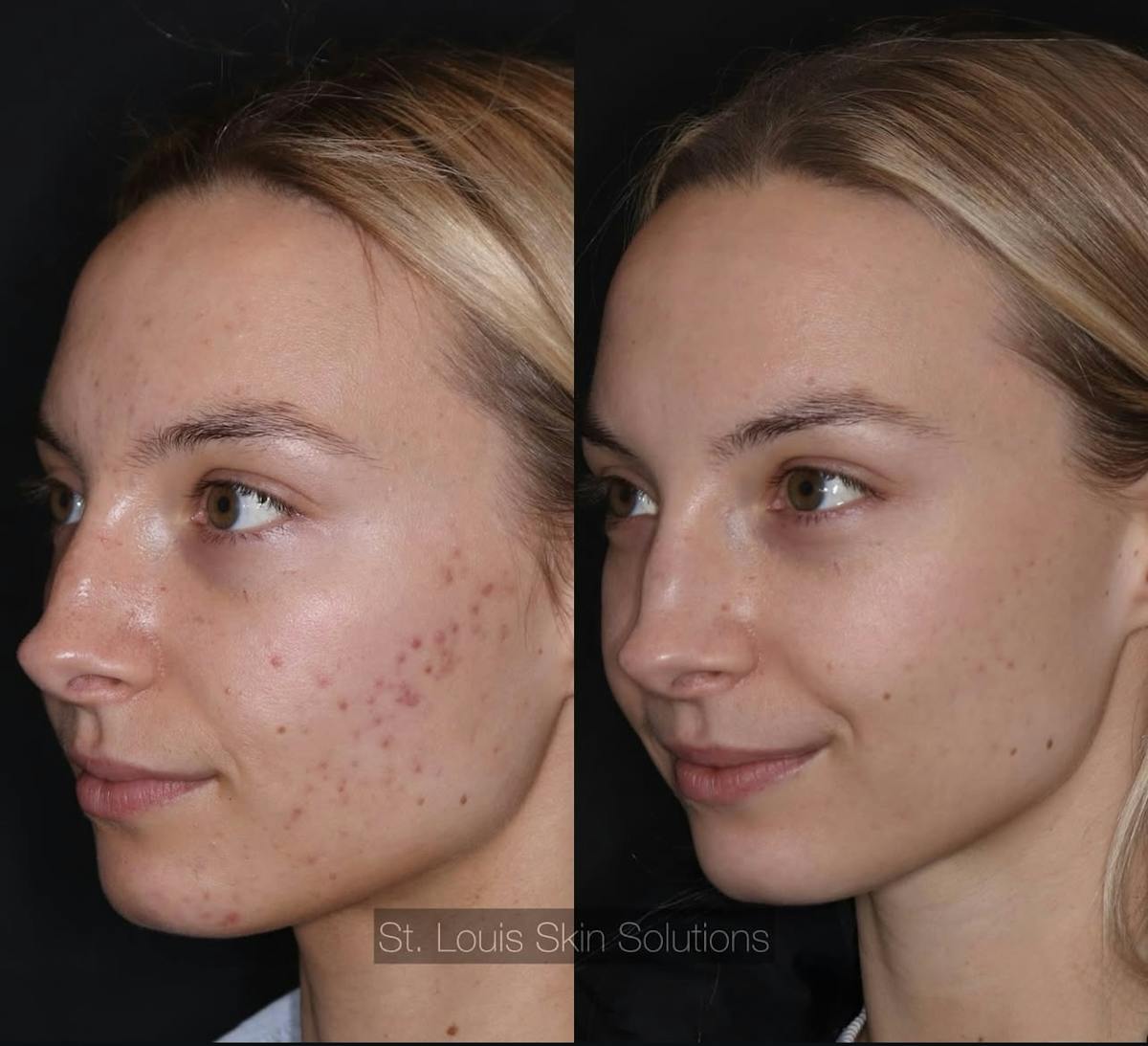 Acne Treatments Before & After Gallery - Patient 225927 - Image 1