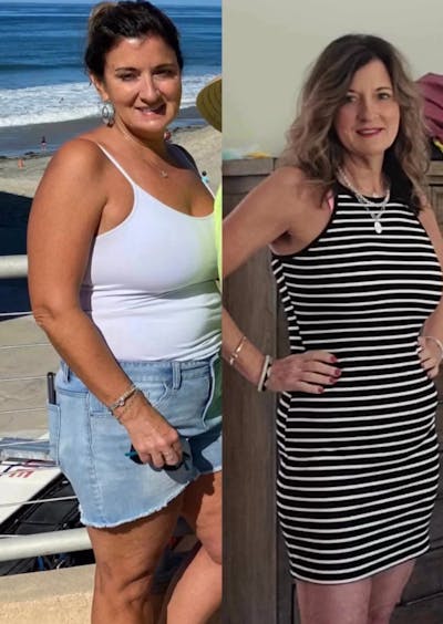 Weight Loss Before & After Gallery - Patient 135920 - Image 1