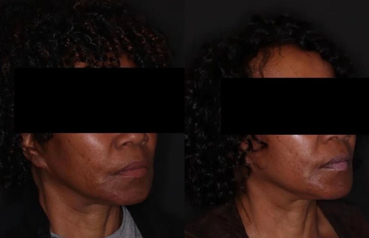 Fillers Before & After Gallery - Patient 310296 - Image 2