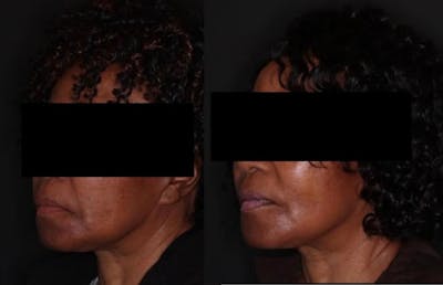 Fillers Before & After Gallery - Patient 310296 - Image 1