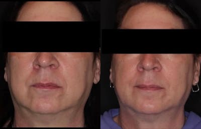 Fillers Before & After Gallery - Patient 383803 - Image 1