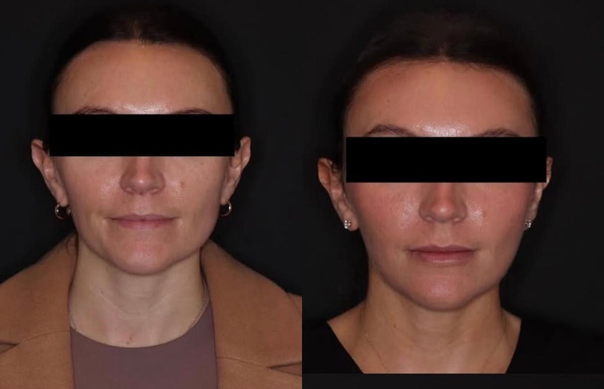 Neurotoxins Before & After Gallery - Patient 324591 - Image 1