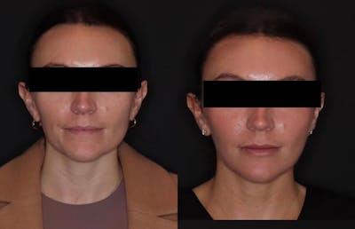 Neurotoxins Before & After Gallery - Patient 324591 - Image 1