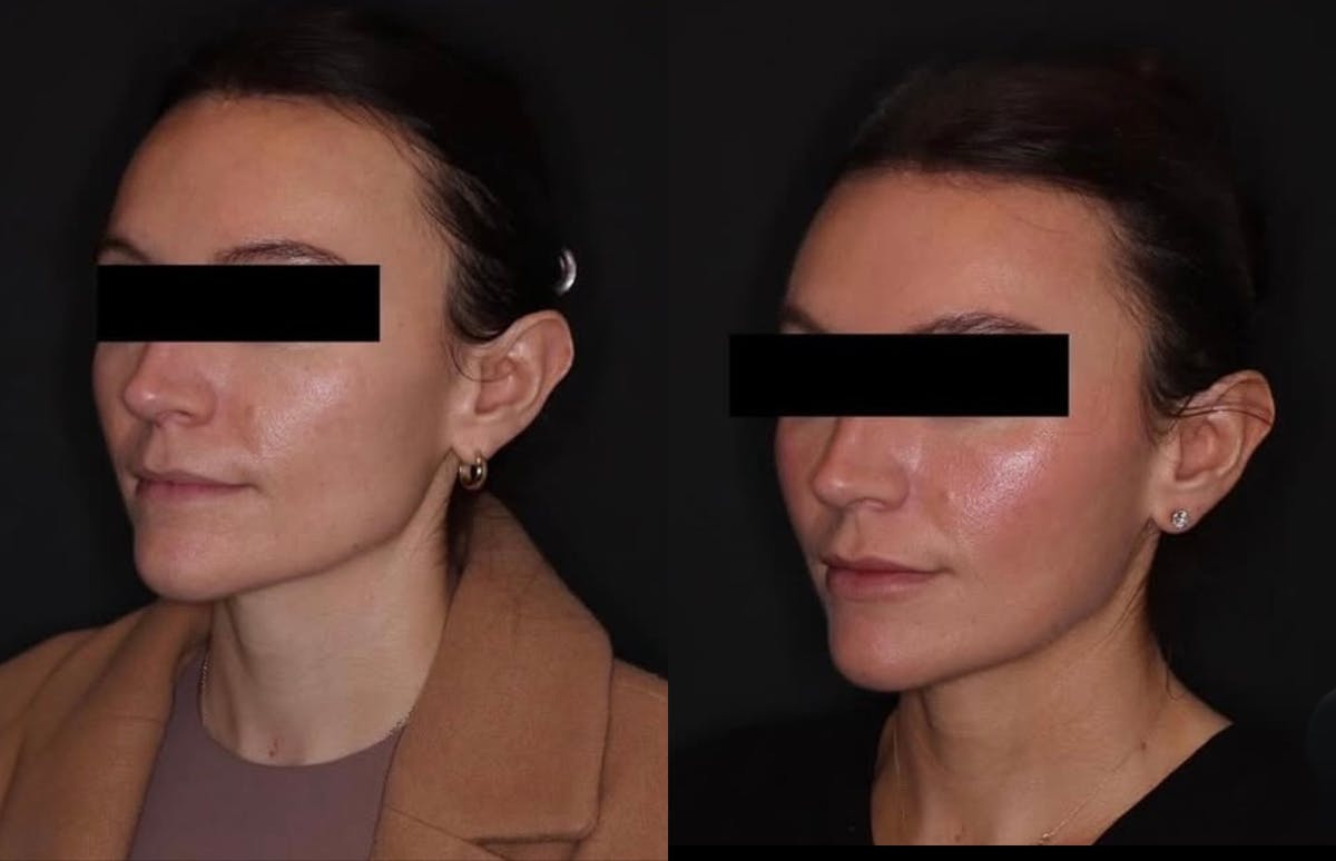 Neurotoxins Before & After Gallery - Patient 324591 - Image 2