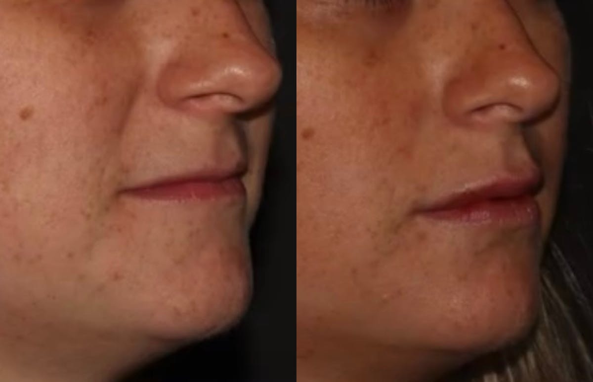 Fillers Before & After Gallery - Patient 367265 - Image 3
