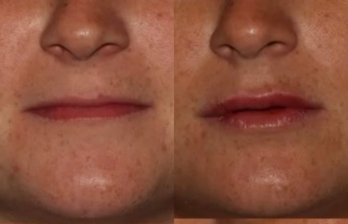 Fillers Before & After Gallery - Patient 367265 - Image 1