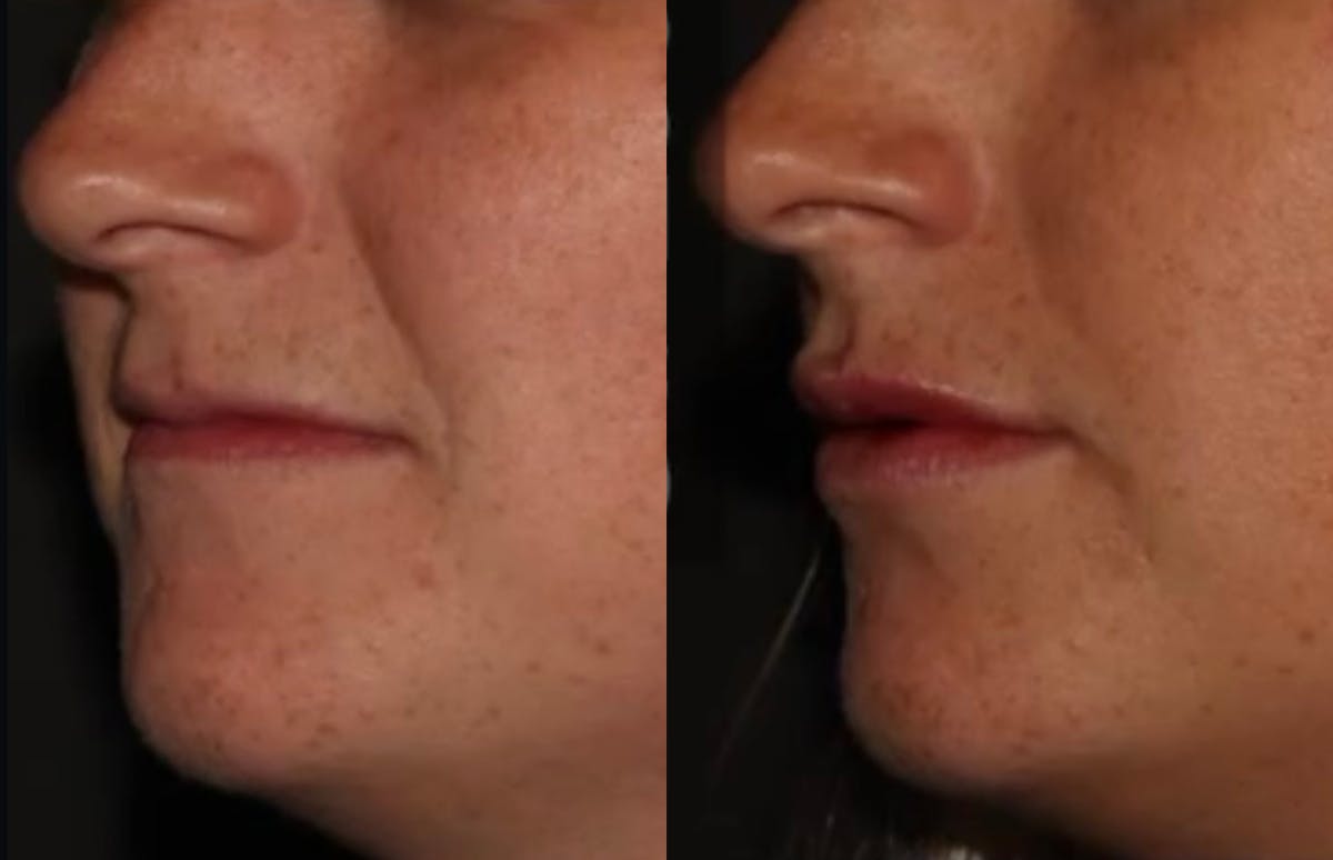 Fillers Before & After Gallery - Patient 367265 - Image 2