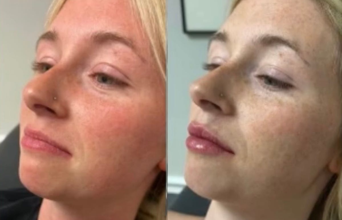 Fillers Before & After Gallery - Patient 771358 - Image 1