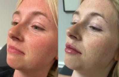 Fillers Before & After Gallery - Patient 771358 - Image 1