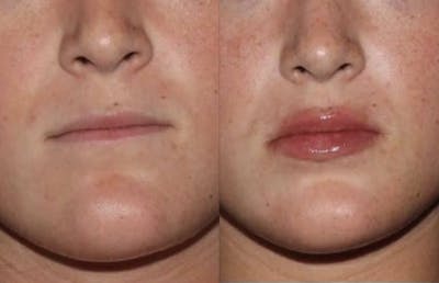 Fillers Before & After Gallery - Patient 411652 - Image 1