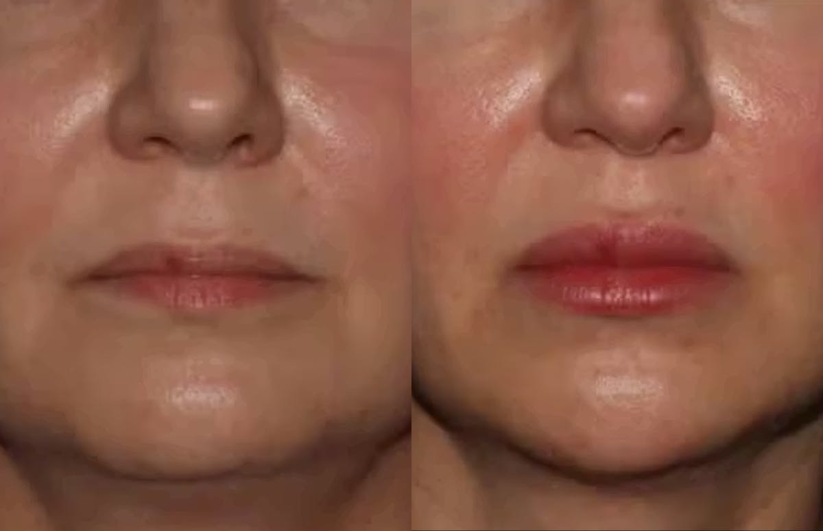Fillers Before & After Gallery - Patient 162911 - Image 1