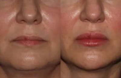 Fillers Before & After Gallery - Patient 162911 - Image 1