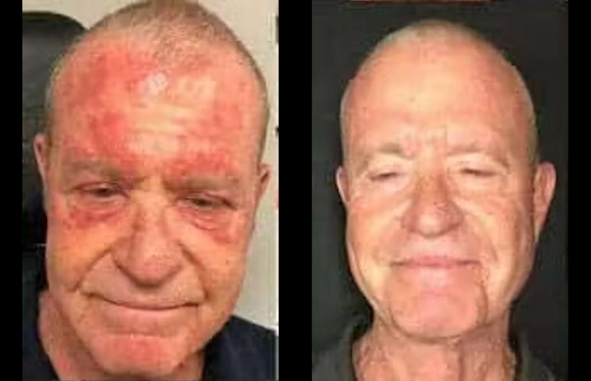 Laser Treatments Before & After Gallery - Patient 340482 - Image 1