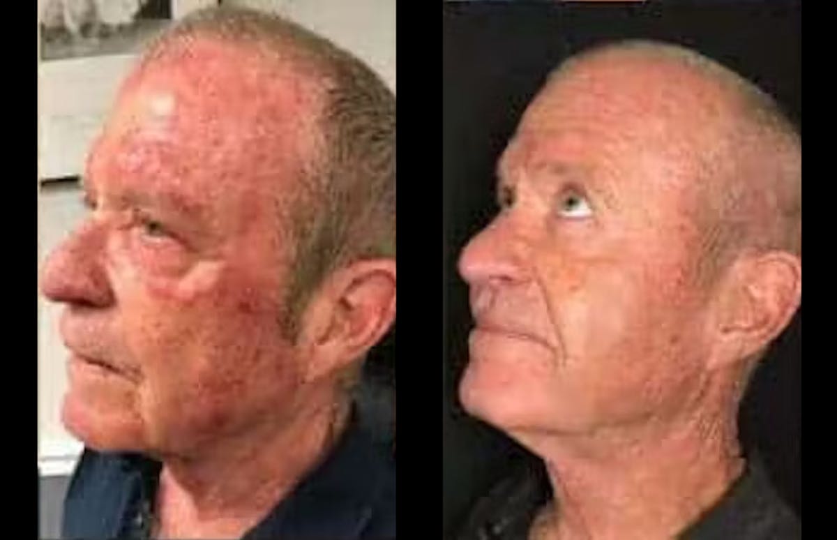 Laser Treatments Before & After Gallery - Patient 340482 - Image 3
