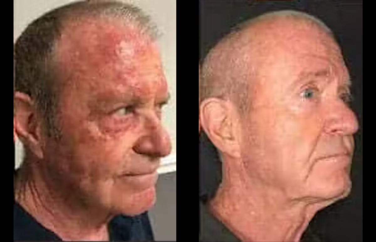 Laser Treatments Before & After Gallery - Patient 340482 - Image 2