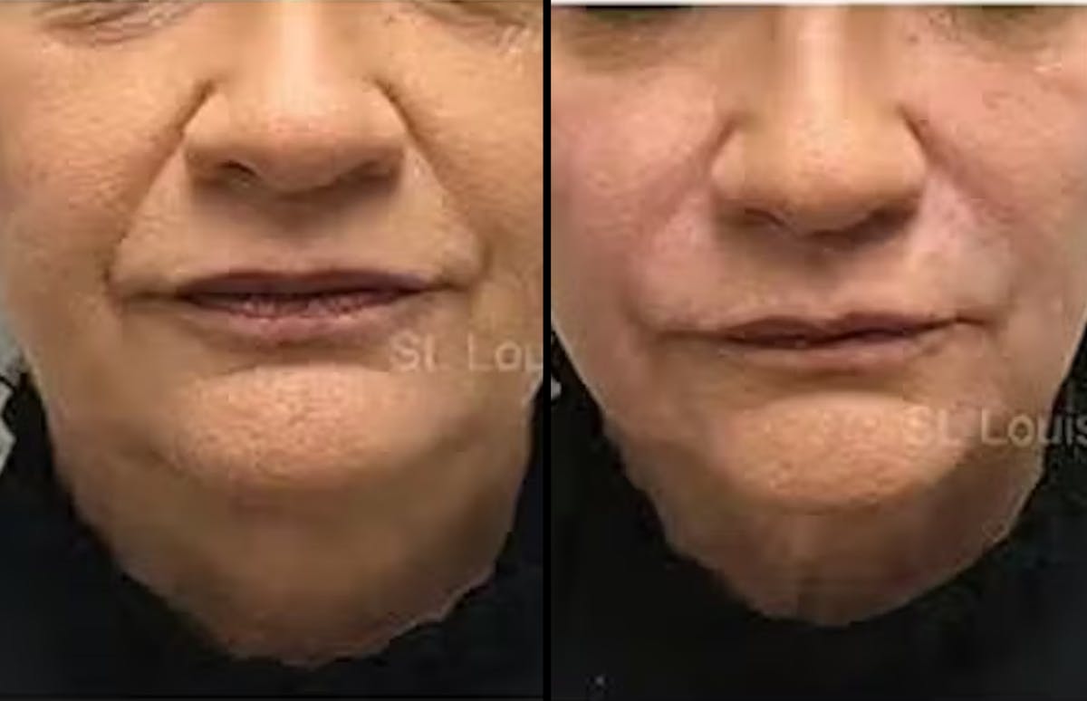 Fillers Before & After Gallery - Patient 203652 - Image 1