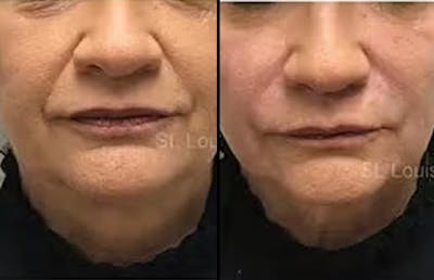 Fillers Before & After Gallery - Patient 203652 - Image 1