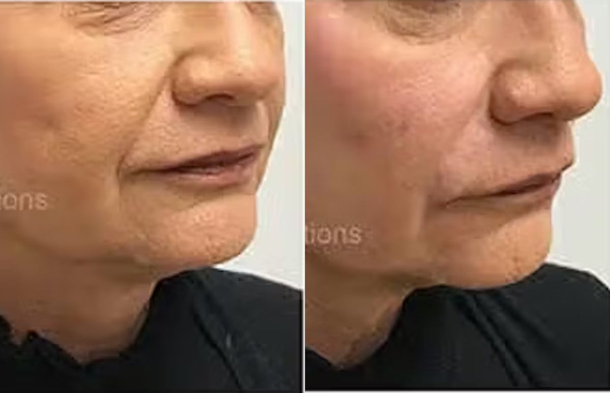 Fillers Before & After Gallery - Patient 203652 - Image 2