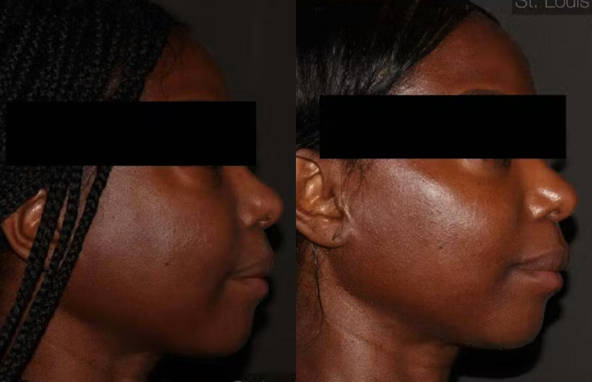 Fillers Before & After Gallery - Patient 275373 - Image 2