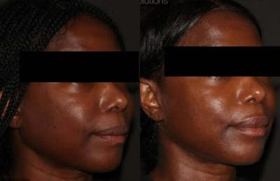 Fillers Before & After Gallery - Patient 275373 - Image 1