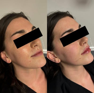 Fillers Before & After Gallery - Patient 295511 - Image 1