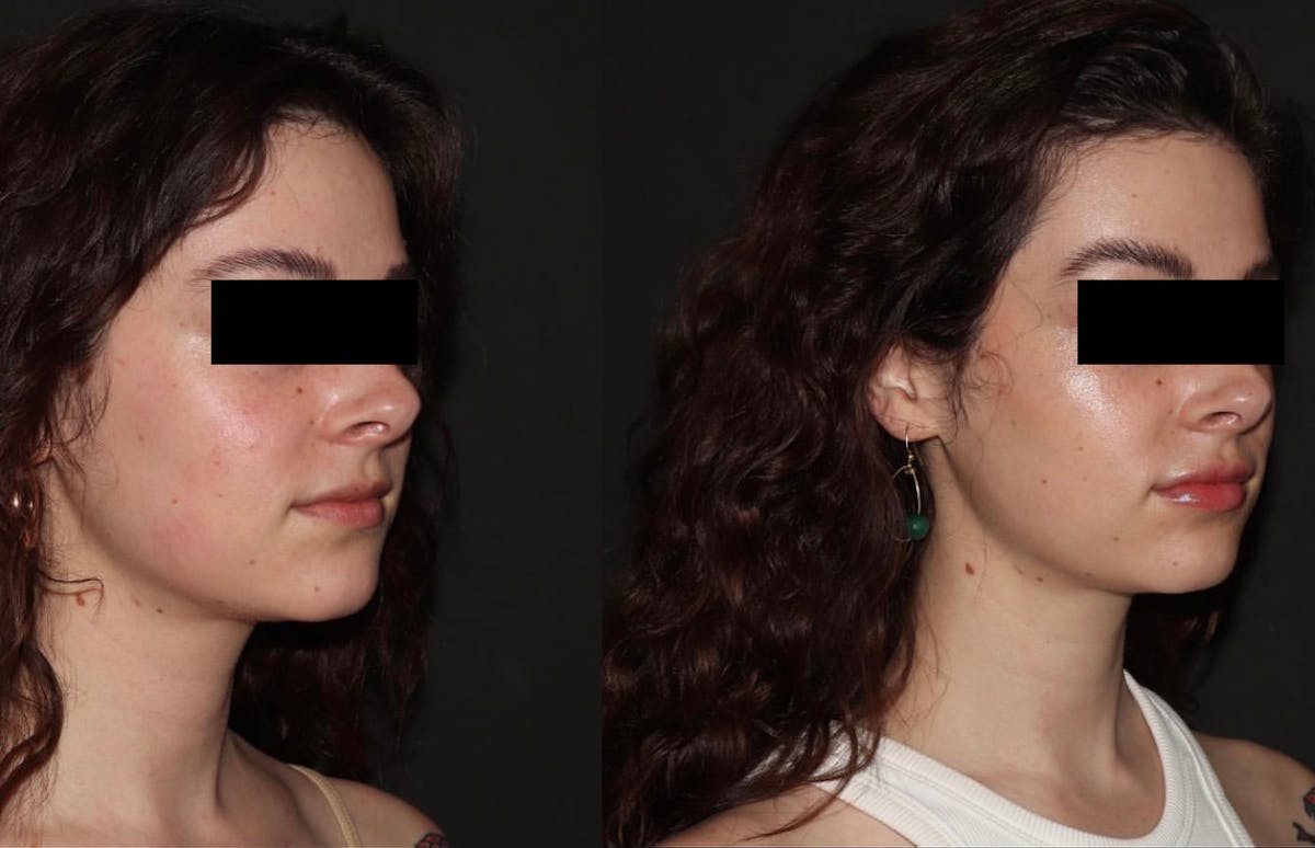 Fillers Before & After Gallery - Patient 211784 - Image 1