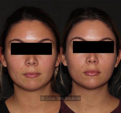 Fillers Before & After Gallery - Patient 197048 - Image 1