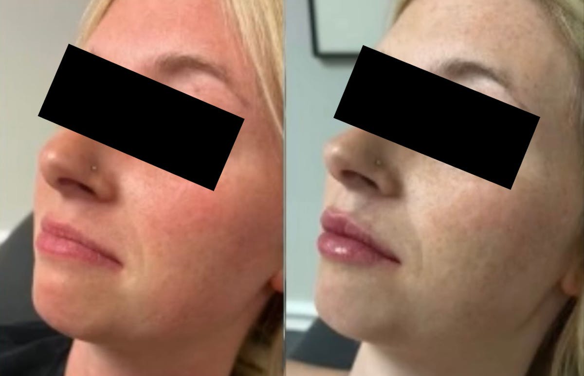 Fillers Before & After Gallery - Patient 771358 - Image 1