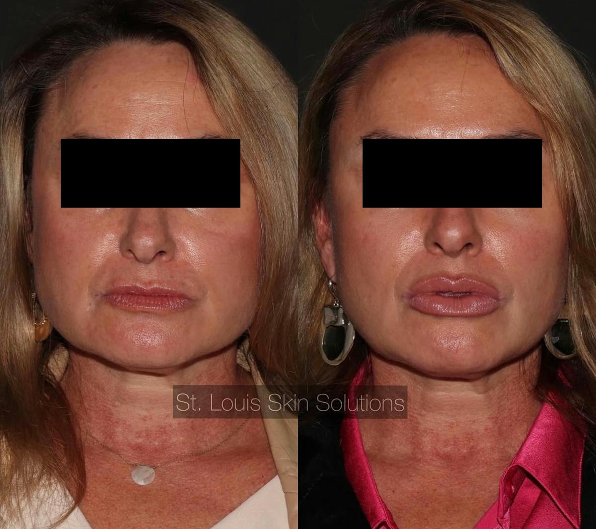 Fillers Before & After Gallery - Patient 397863 - Image 1