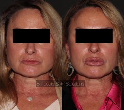 Fillers Before & After Gallery - Patient 397863 - Image 1
