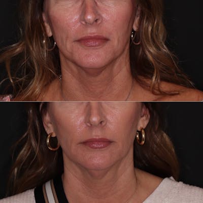 Fillers Before & After Gallery - Patient 403138 - Image 1