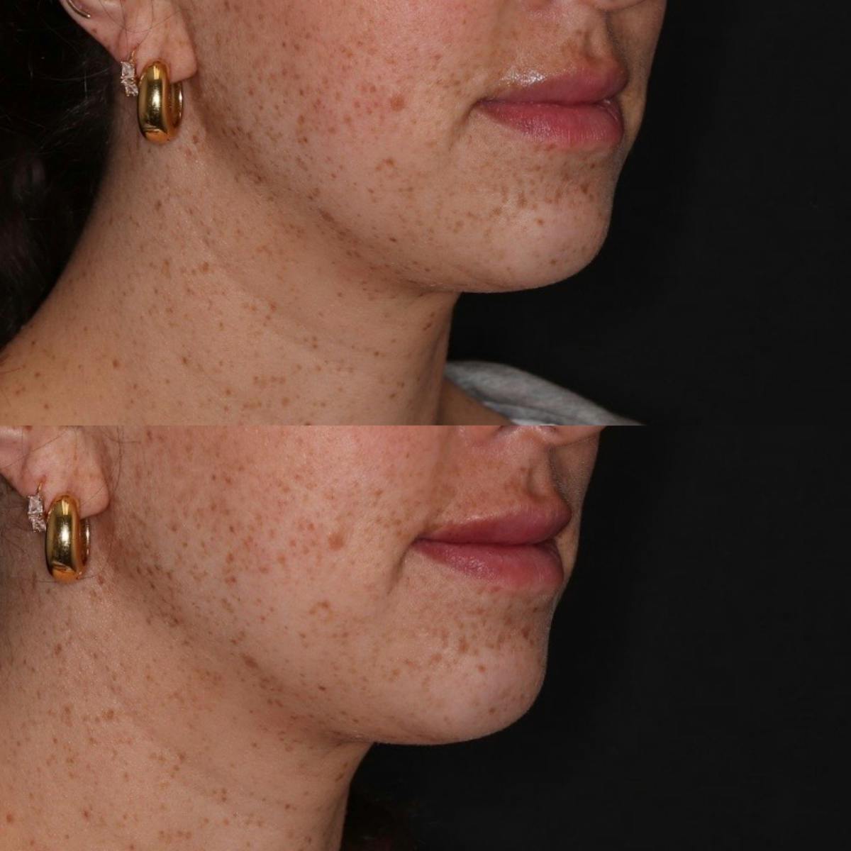Fillers Before & After Gallery - Patient 308061 - Image 1