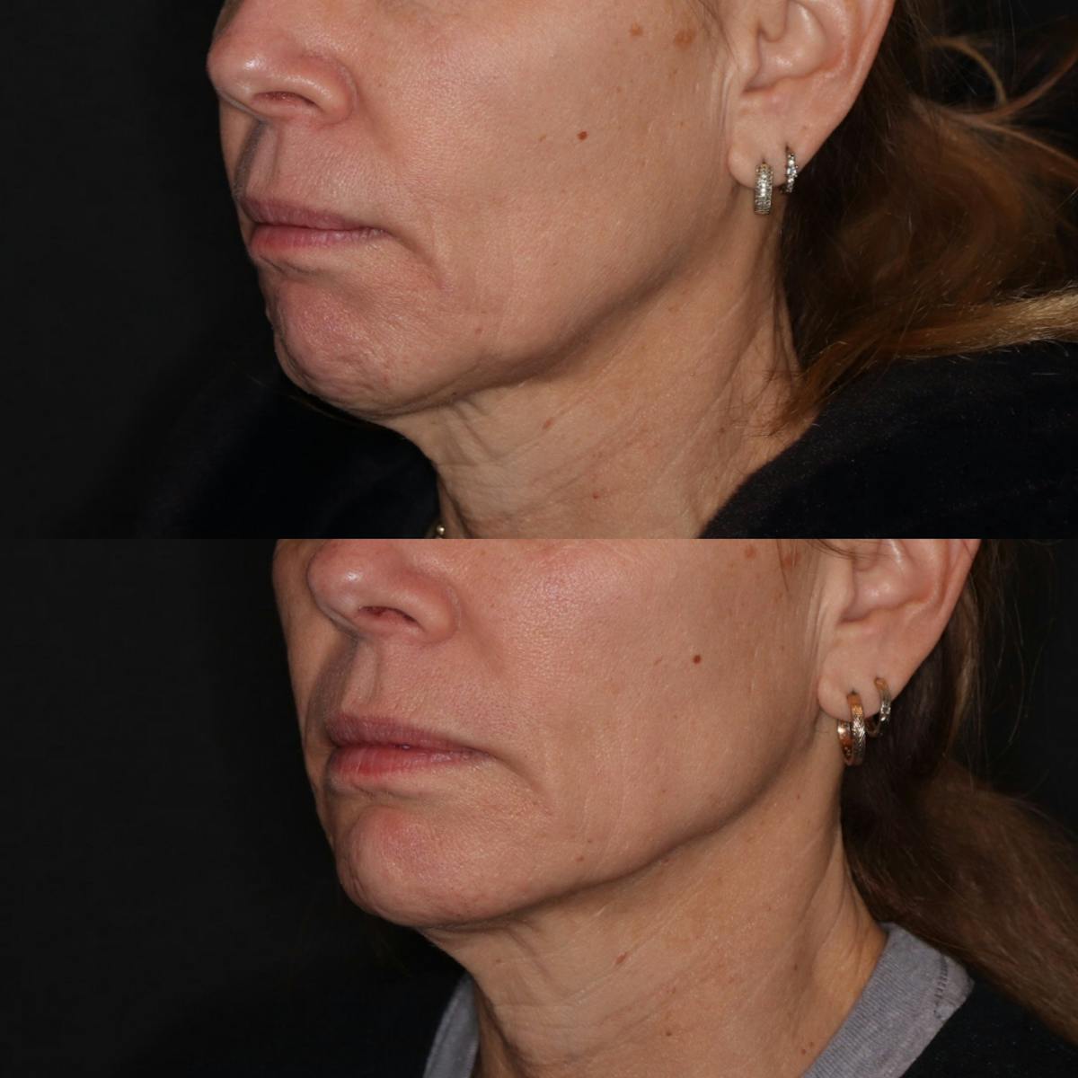Fillers Before & After Gallery - Patient 417393 - Image 1