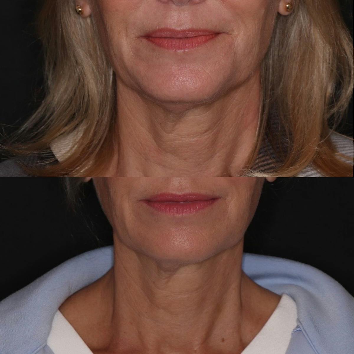 Fillers Before & After Gallery - Patient 498457 - Image 1