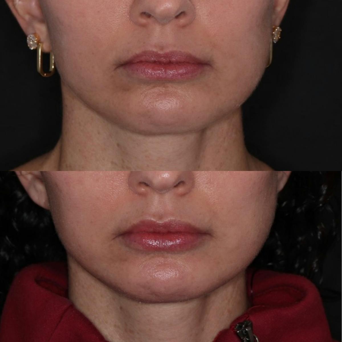 Fillers Before & After Gallery - Patient 138896 - Image 1