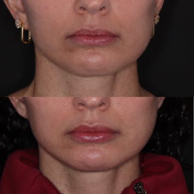 Fillers Before & After Gallery - Patient 138896 - Image 1