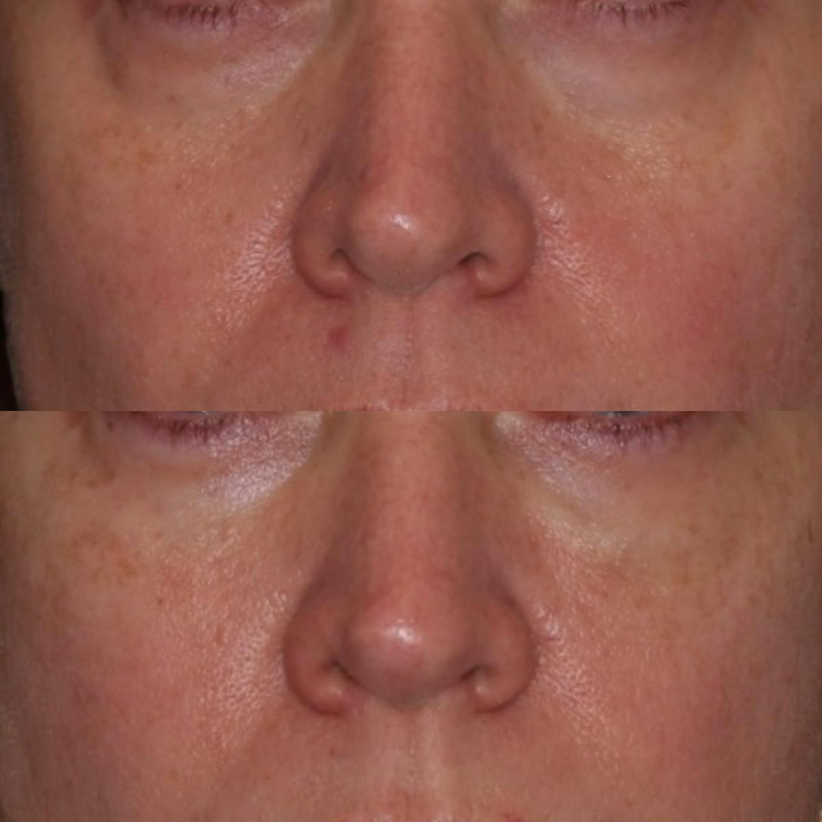 Fillers Before & After Gallery - Patient 390175 - Image 1