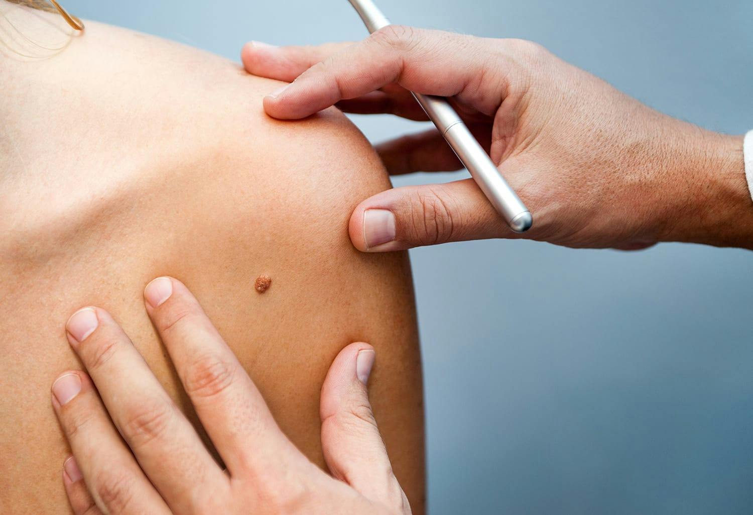 Woman getting a mole examined
