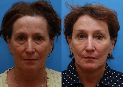 Brow Lift Before & After Gallery - Patient 405470 - Image 1