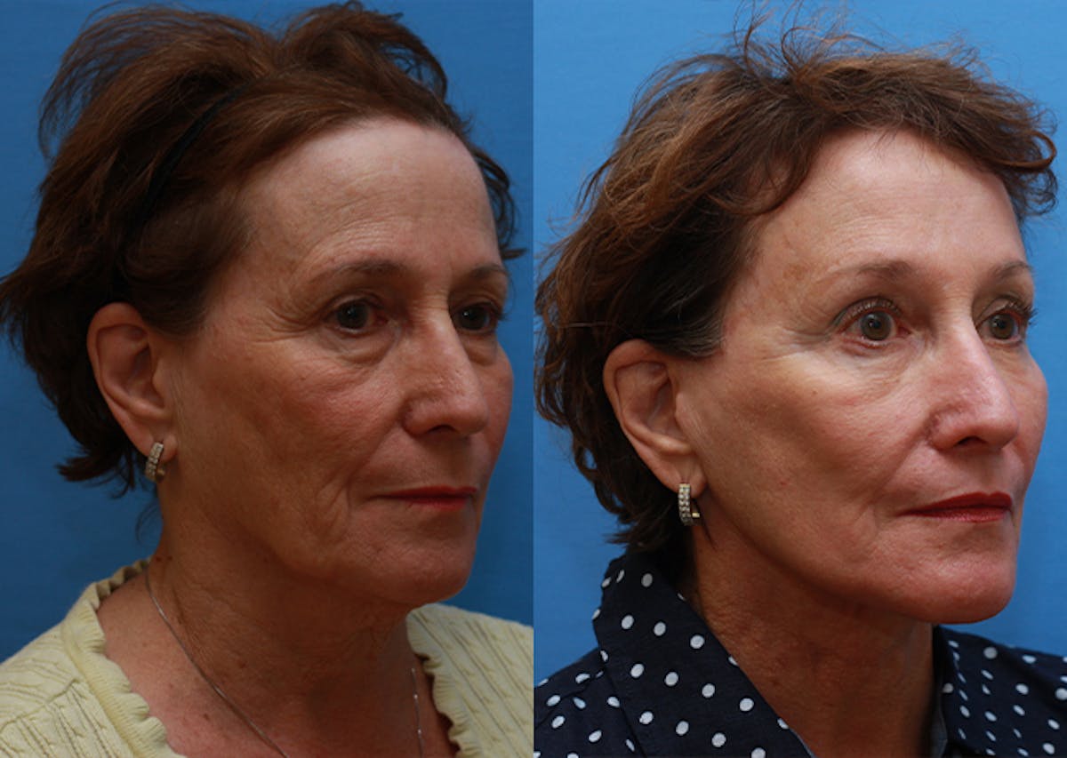 Brow Lift Before & After Gallery - Patient 405470 - Image 2