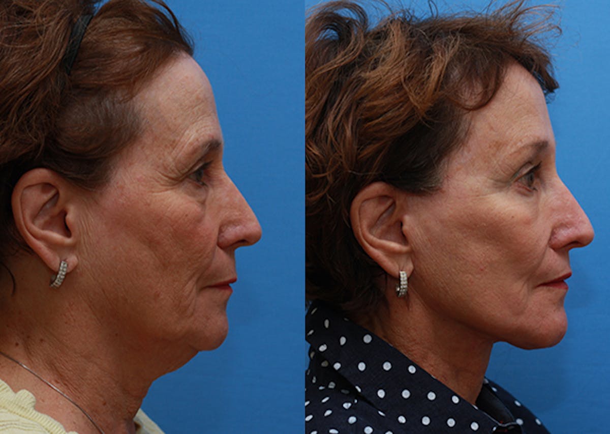 Brow Lift Before & After Gallery - Patient 405470 - Image 3