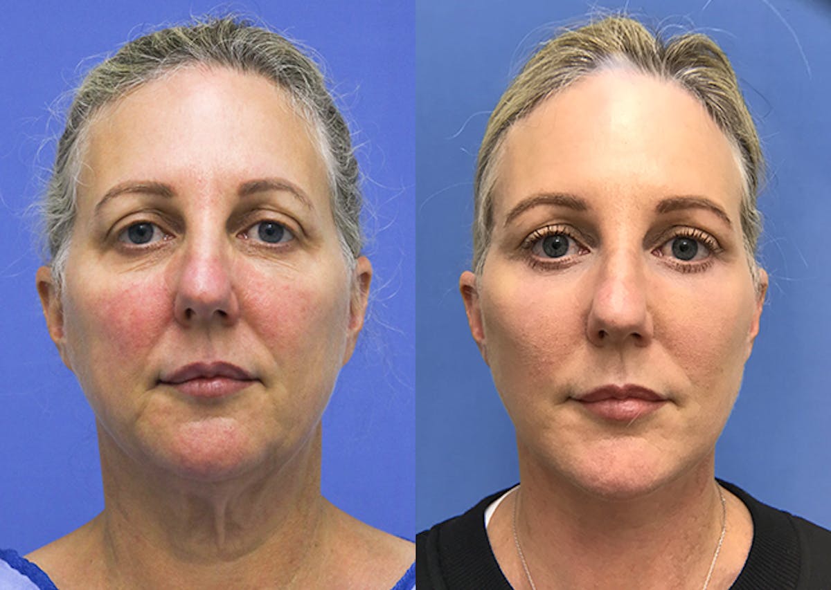 Neck Before & After Gallery - Patient 348644 - Image 1