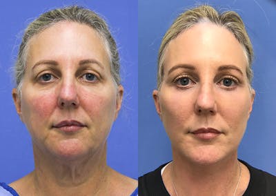 Neck Before & After Gallery - Patient 348644 - Image 1