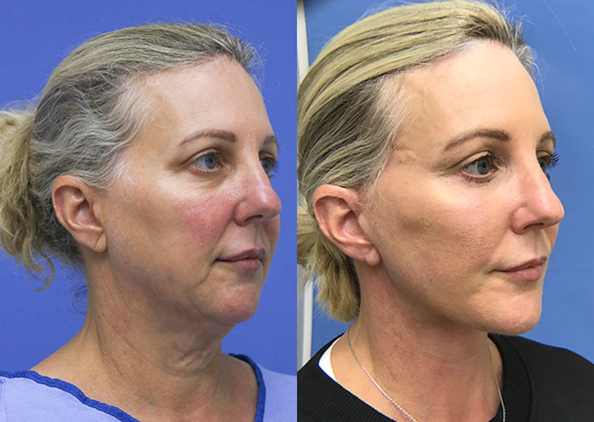 Neck Before & After Gallery - Patient 348644 - Image 2