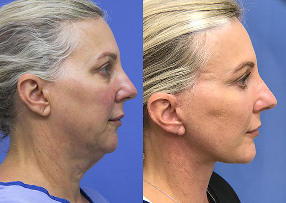 Neck Before & After Gallery - Patient 348644 - Image 3