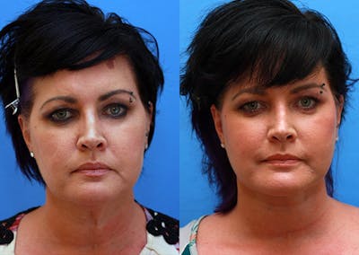 Neck Before & After Gallery - Patient 995037 - Image 1