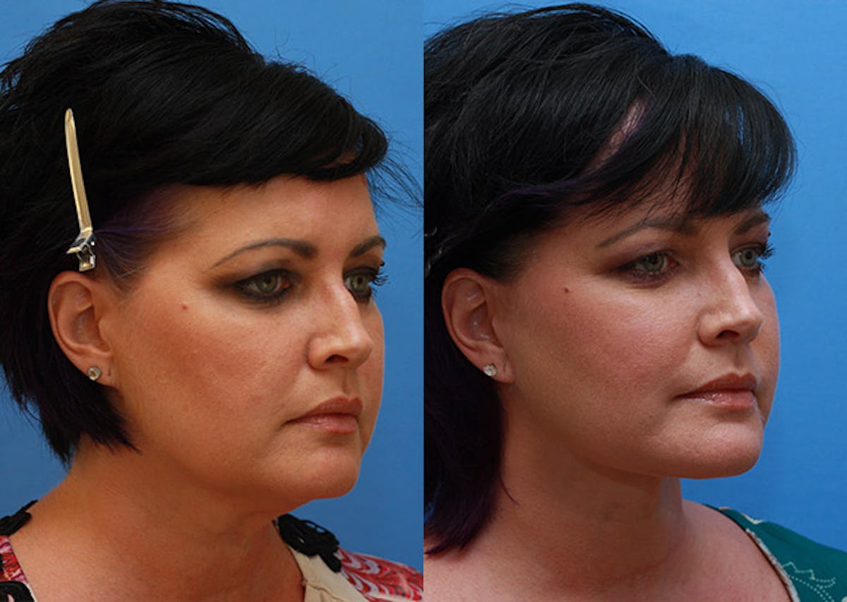 Neck Before & After Gallery - Patient 995037 - Image 2