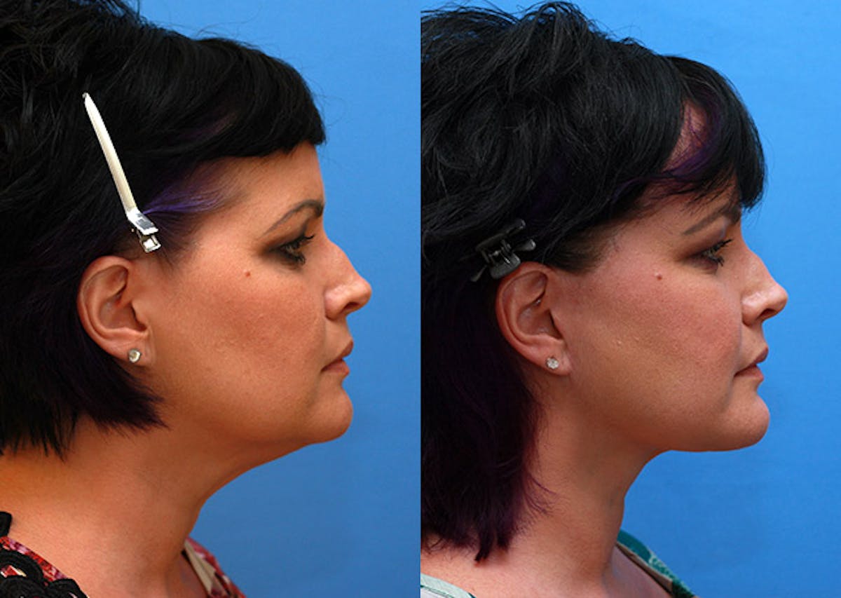 Neck Before & After Gallery - Patient 995037 - Image 3