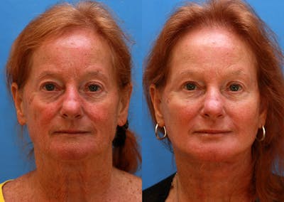 Neck Before & After Gallery - Patient 111467 - Image 1